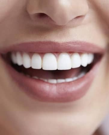 Close-up of a patient's bright white smile showing healthy teeth and natural gum line.
