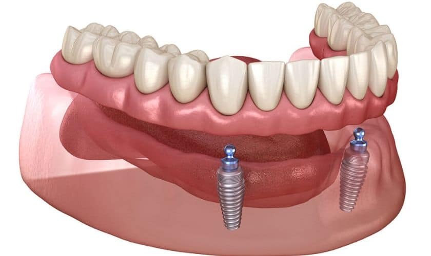 Dental implant illustration showing prosthetic teeth supported by two titanium implants in the jawbone.
