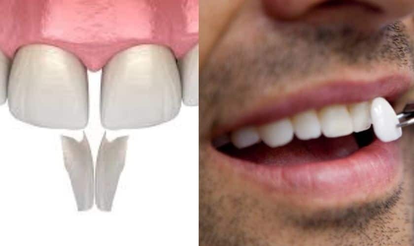 Comparison of dental veneers and bonding showing tooth shape and placement on a patient's smile.