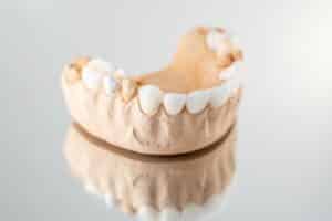 Dental model showing white porcelain veneers on front teeth for cosmetic dentistry demonstration.