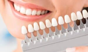 Smile comparison showing tooth shade guide with natural teeth next to veneer color samples.