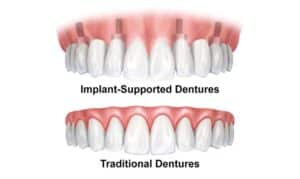 Implant-supported dentures compared to traditional dentures in Niceville, FL.