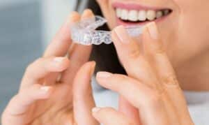 Woman inserting clear Invisalign aligners to straighten teeth as part of her daily orthodontic treatment.