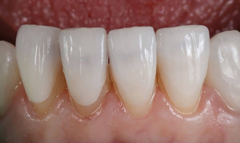 Close-up of four natural-looking bonded teeth showing smooth, white surfaces with proper contours in Niceville.