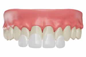 Dental veneer mockup showing white porcelain veneers on front teeth with natural gum line.