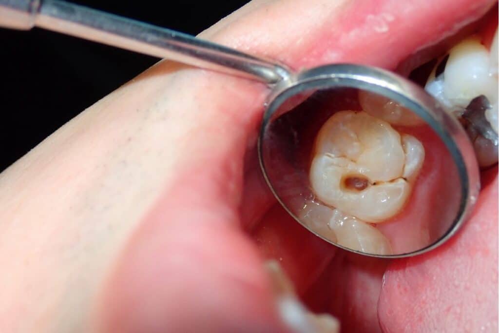 Dental mirror showing tooth with cavity and brown discoloration requiring treatment.