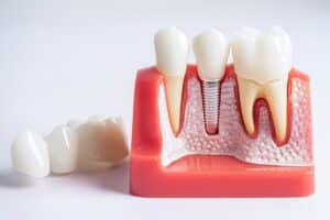 Dental implant model showing natural tooth replacement with crown and titanium post in Niceville.