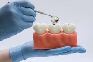 Dentist examining dental model showing three teeth with decay demonstration tool.